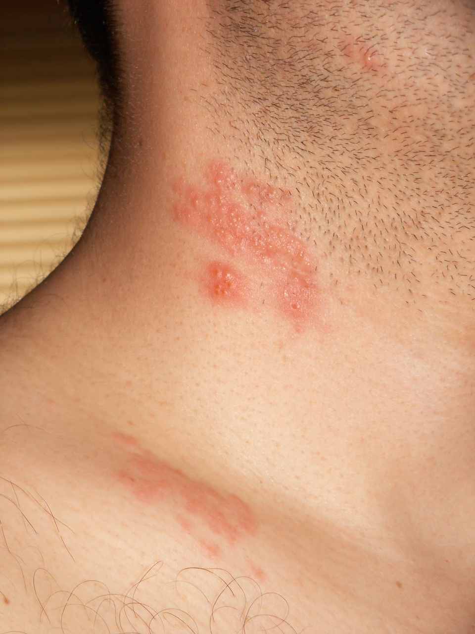 Como Prevenir a herpes zoster?