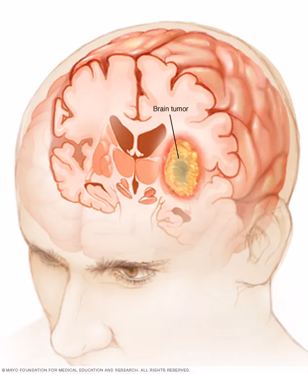 Can chemotherapy treat a brain tumor headache?