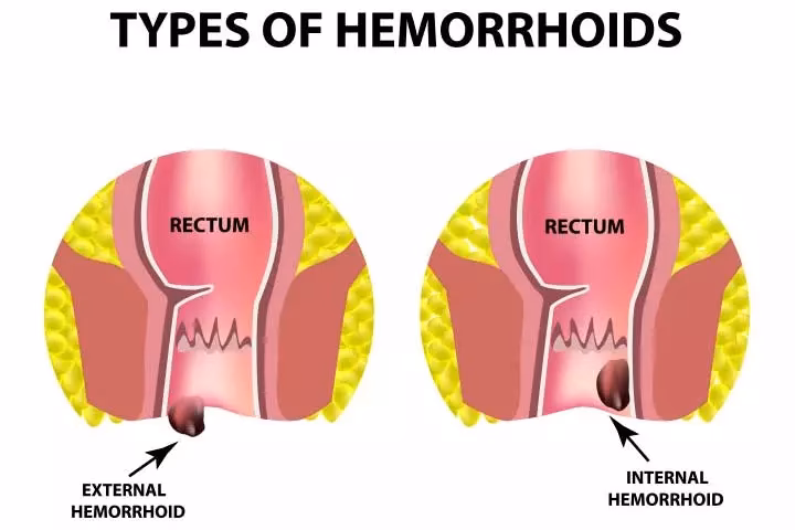 How common are hemorrhoids during pregnancy?