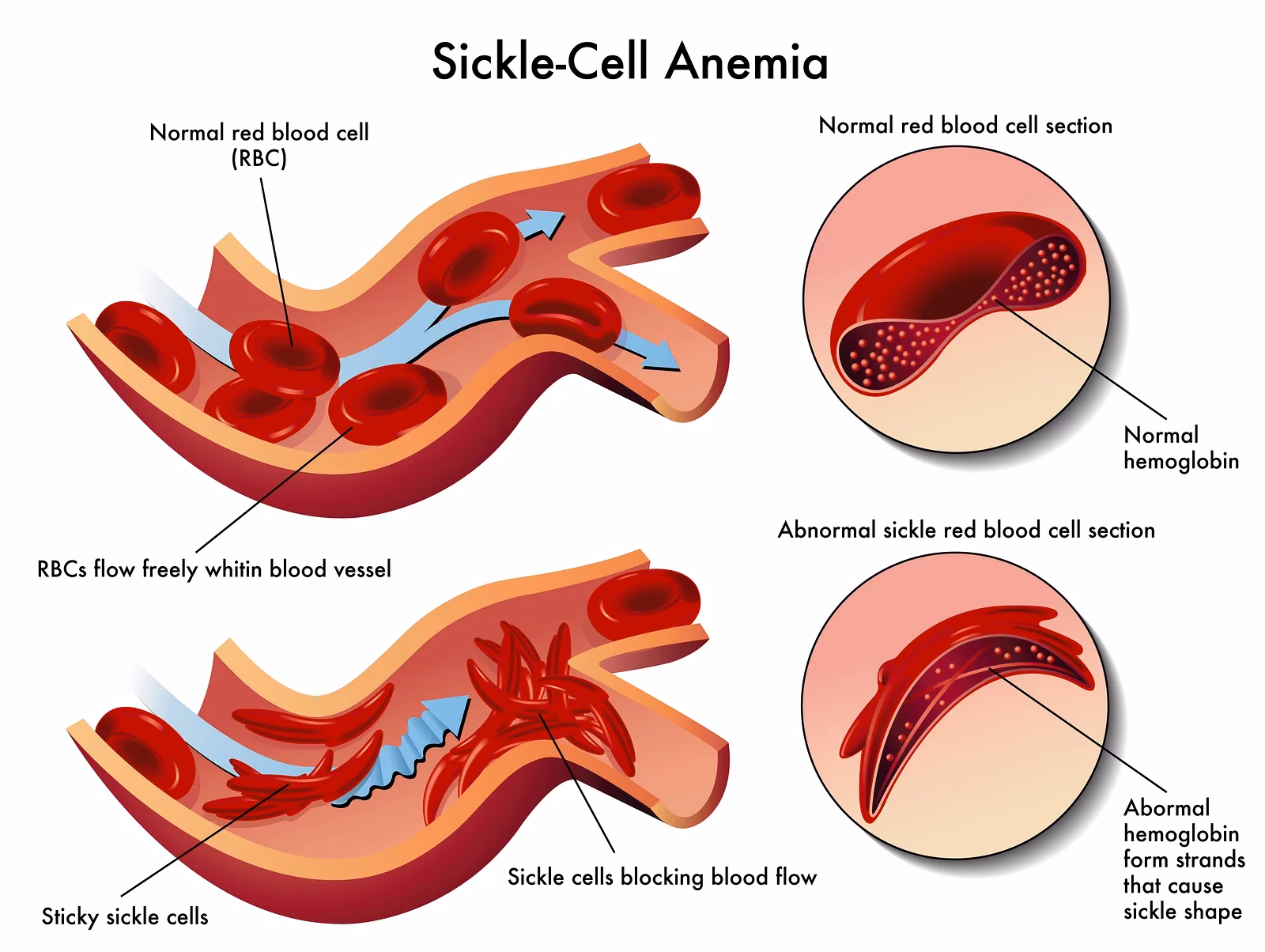 What is sickle cell anaemia?