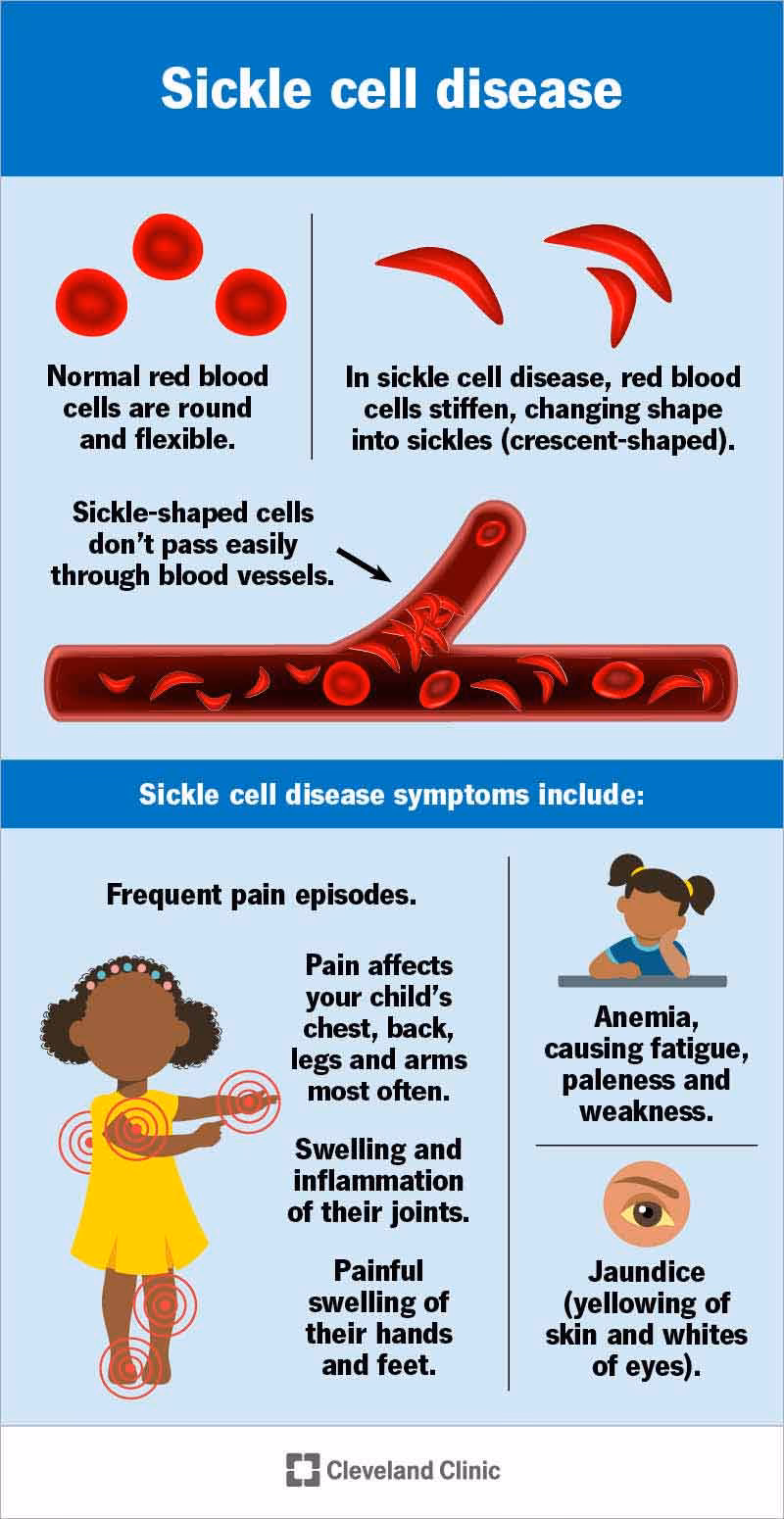 What is Sickle Cell Anemia (SCD)?