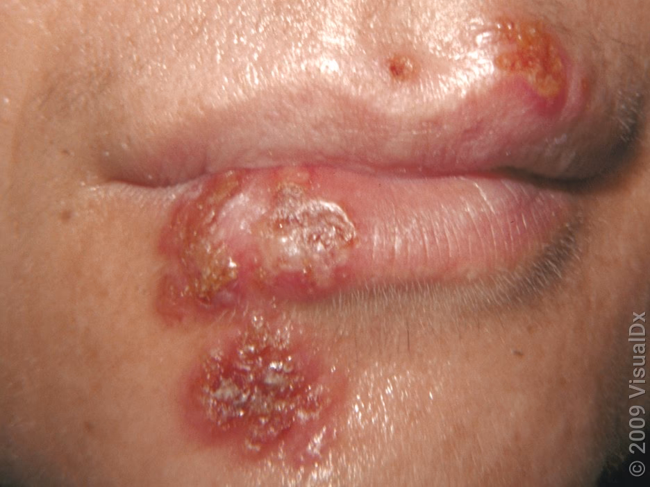 What are the stages of cold sore (fever blister) formation?