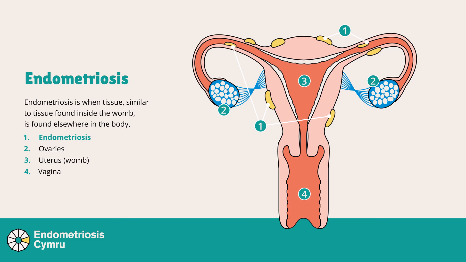 What is Stage 4 endometriosis?