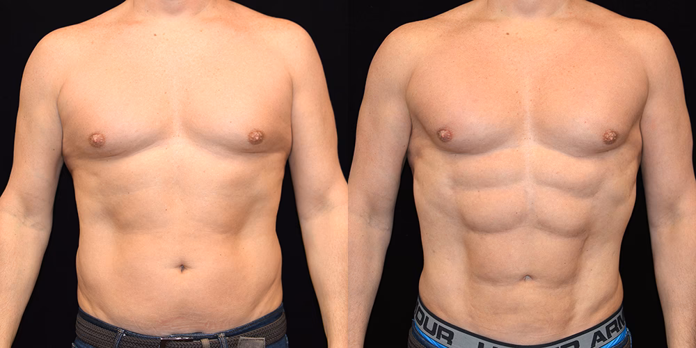 Should I consider getting a six-pack surgery?