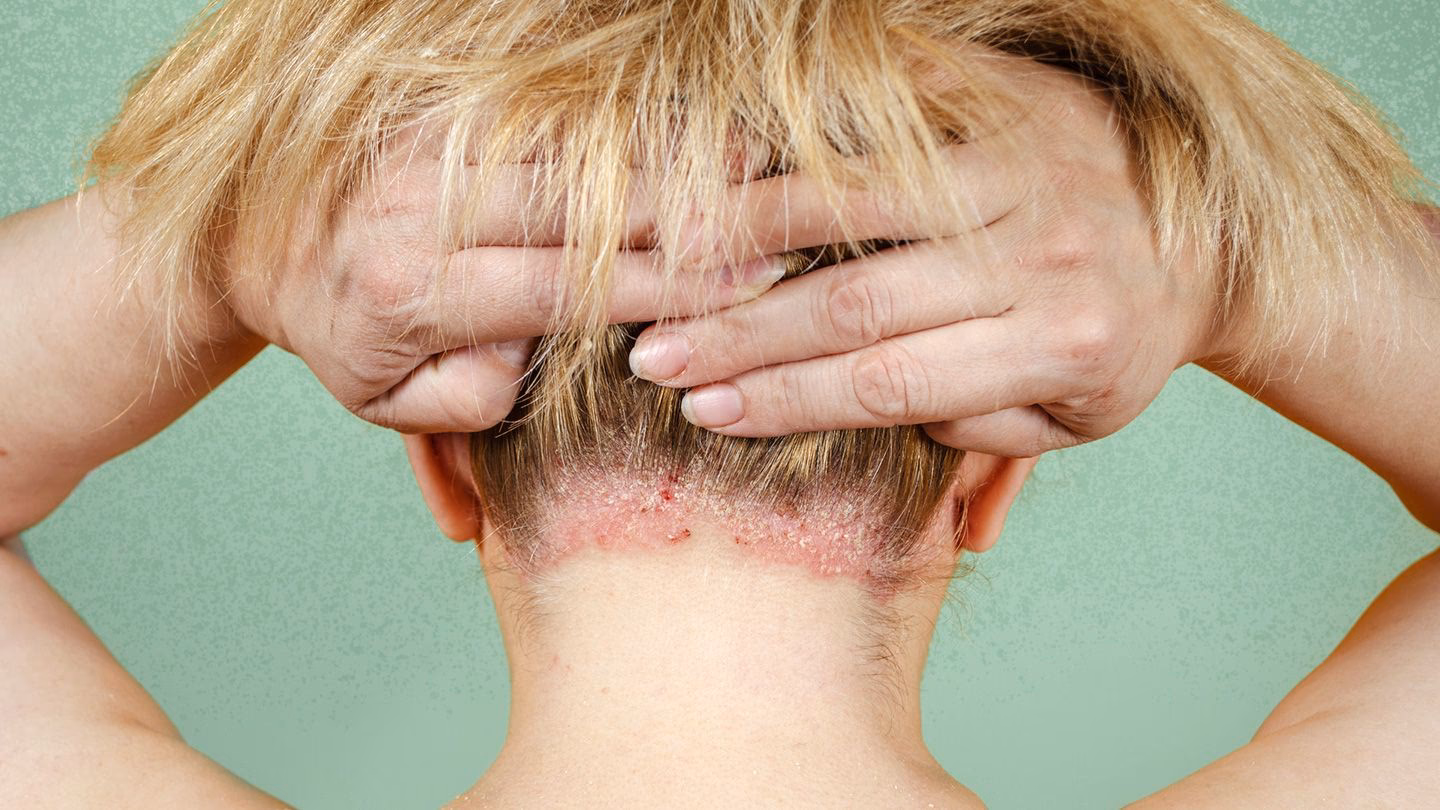 How does scalp psoriasis affect your hair?