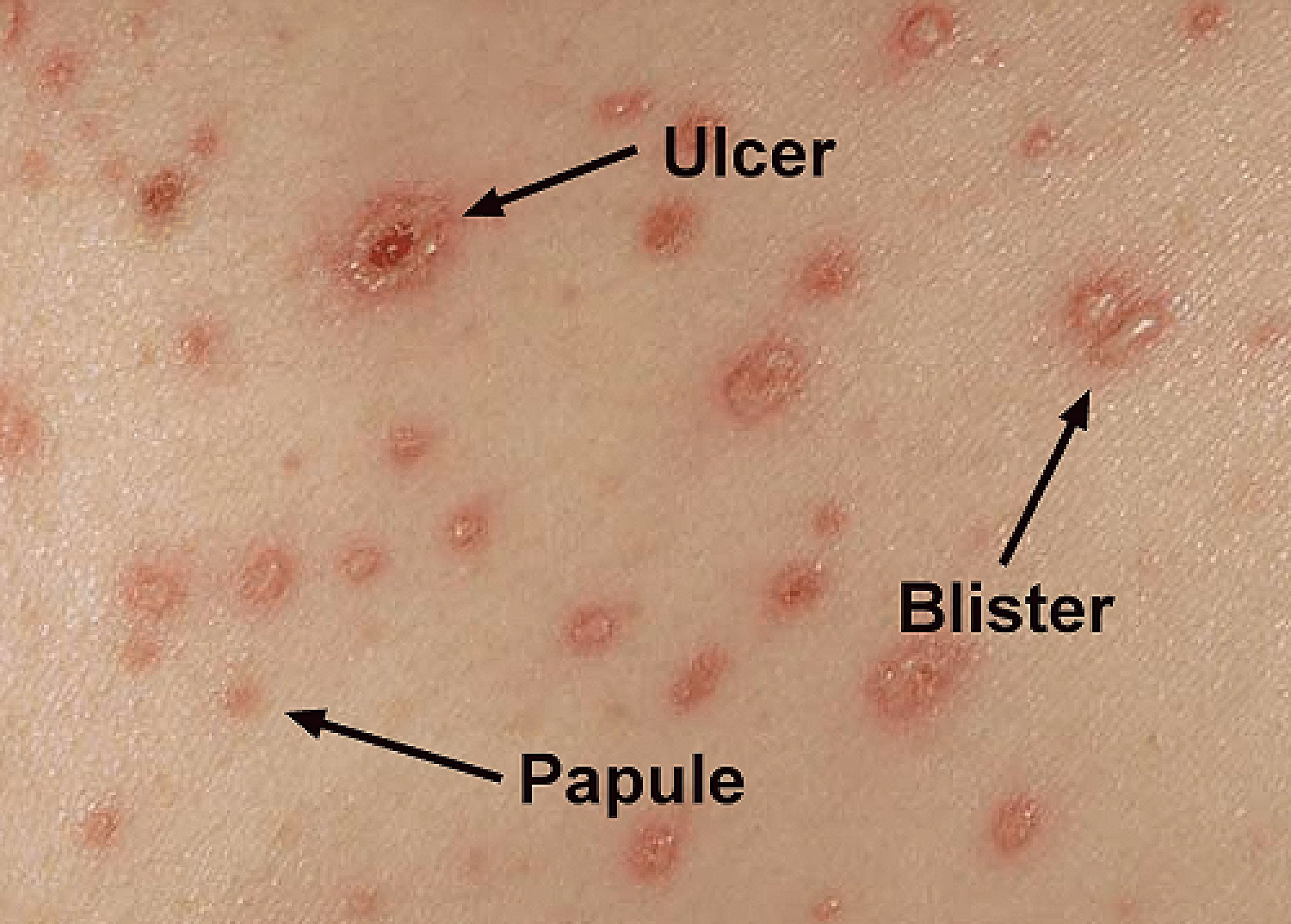 What are the most common chickenpox complications?
