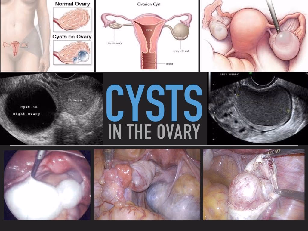 What are endometriosis ovarian cysts?
