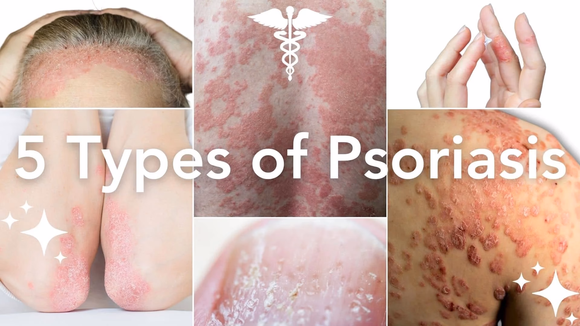 What are the symptoms of psoriasis?