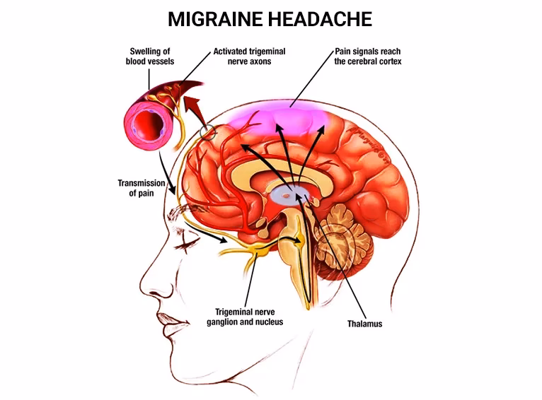 Why do I have a right sided headache?