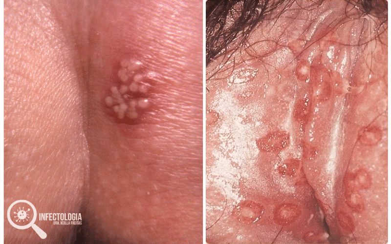 Como é transmitido o vírus da herpes?