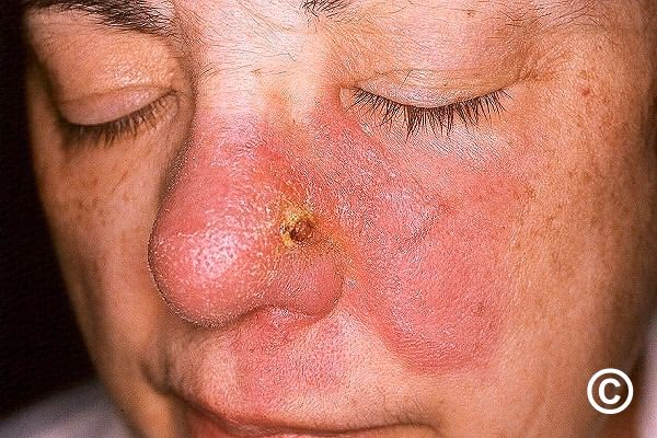 What is sarcoidosis & lupus pernio?