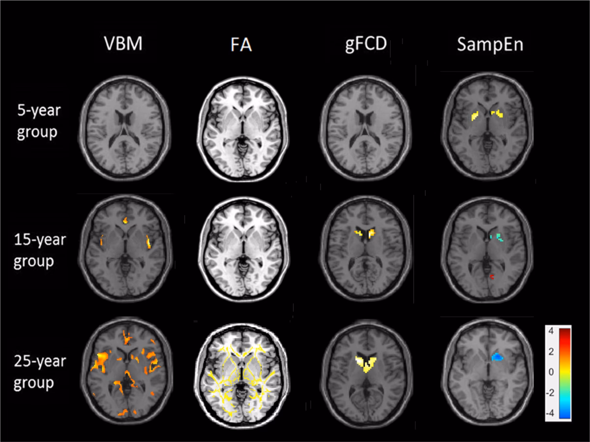 How does schizophrenia affect a person's life?