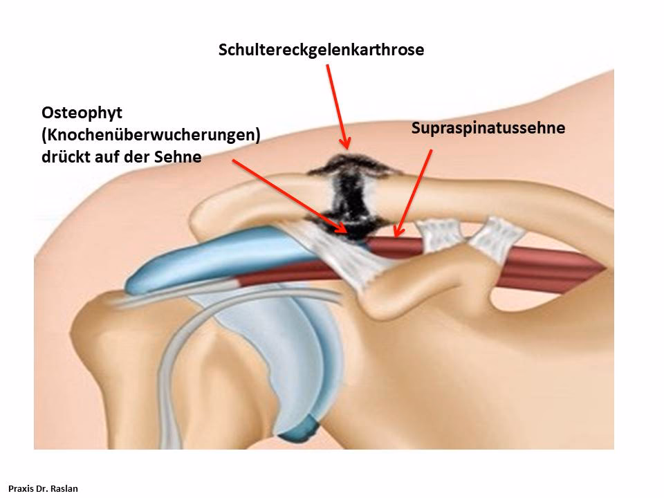 Welche Therapiemethoden sind zur Behandlung der AC-Gelenkverletzung sinnvoll?