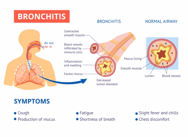 Is chronic bronchitis a long-term condition?