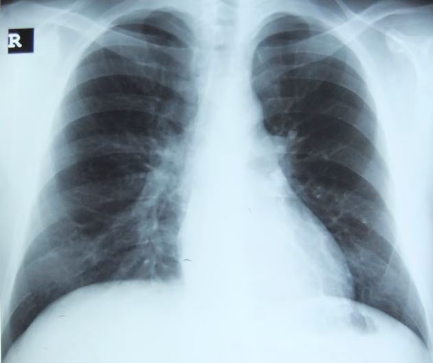 Which atypical organisms are associated with acute bronchitis (cap)?