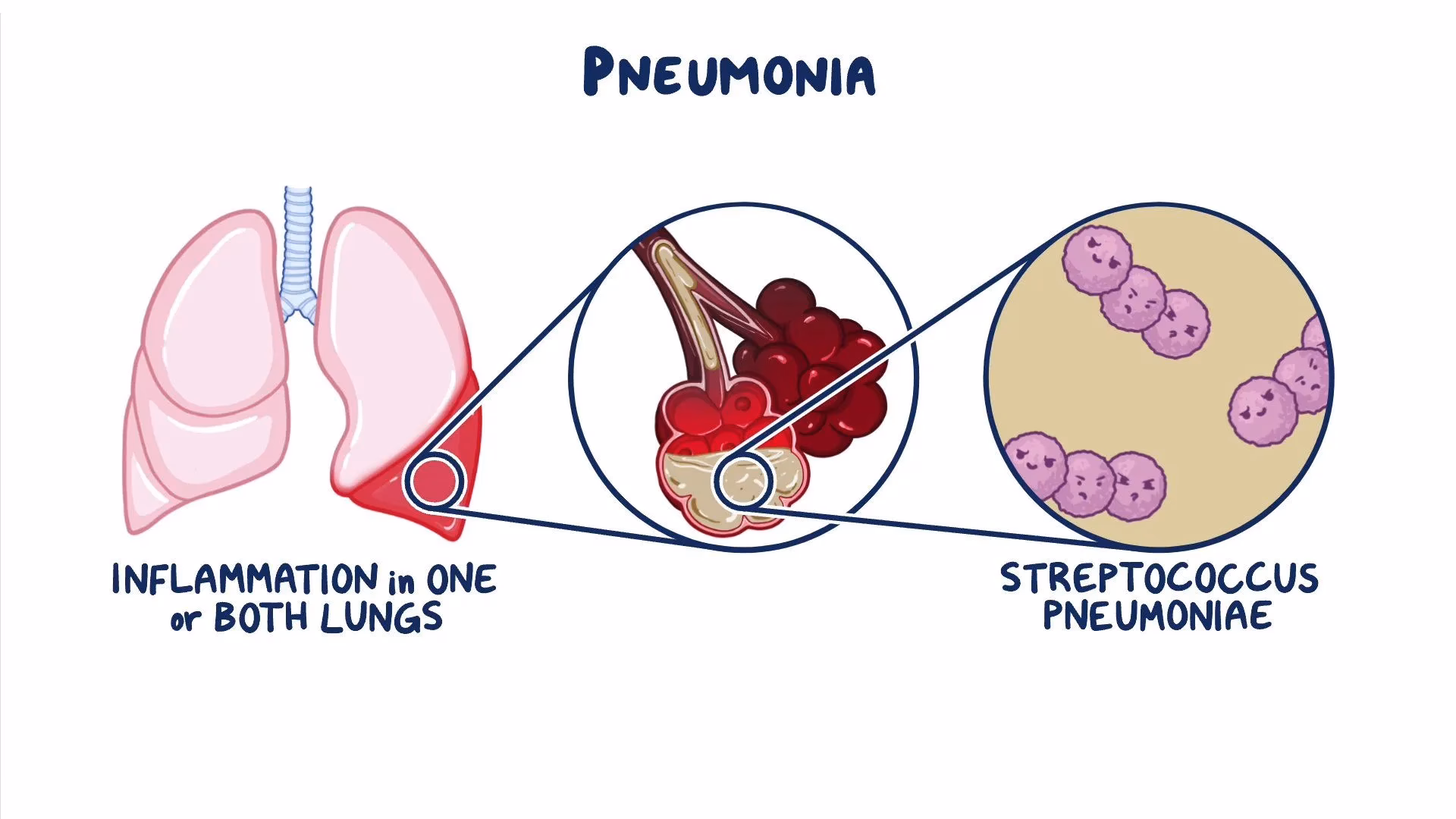 What causes lobar pneumonia and Ards in a postpartum female?