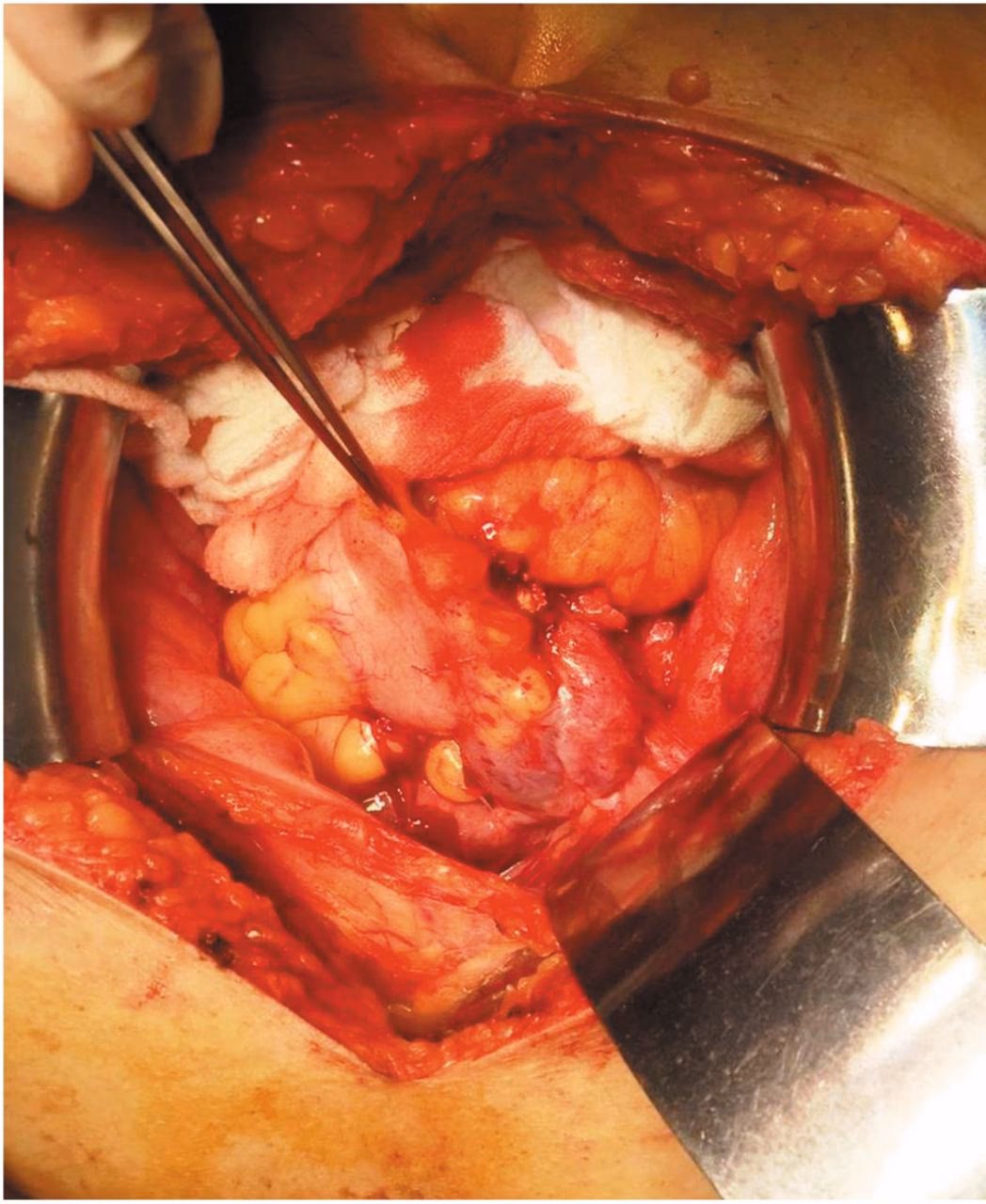 Should I have primary debulking surgery or neoadjuvant chemotherapy?