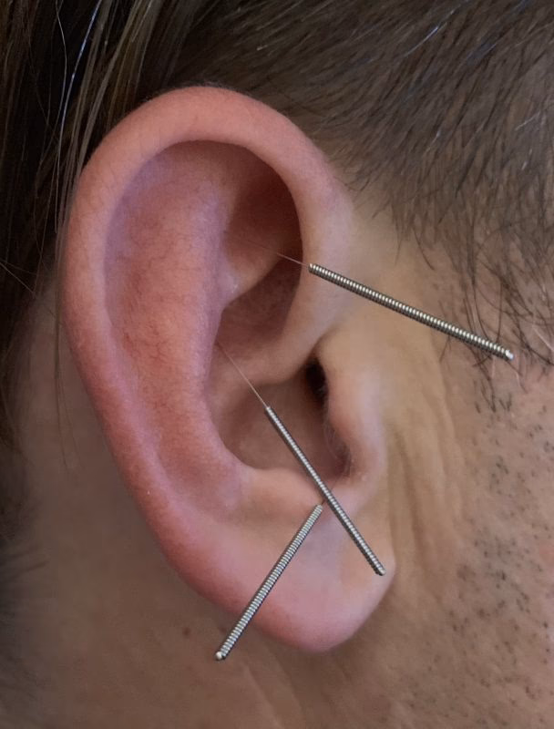 Wie lange dauert es bis Akupunktur wirkt?