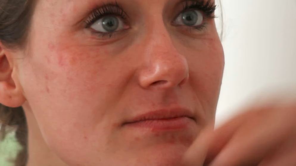 Wie viele Menschen leiden unter der Alkoholallergie?