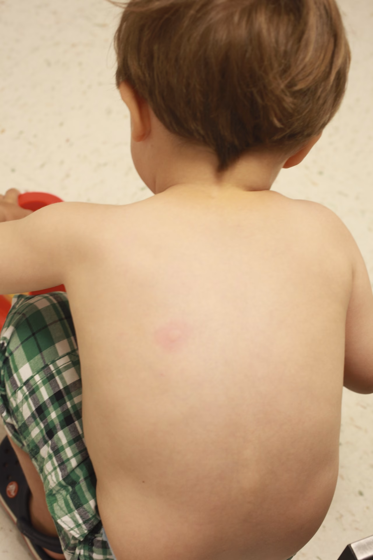 What is an almond allergy?