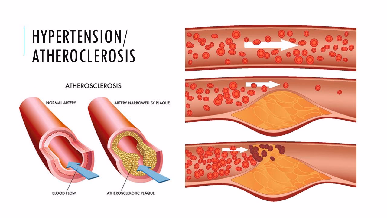 How does hypertensive anaphylactic reaction affect blood pressure?