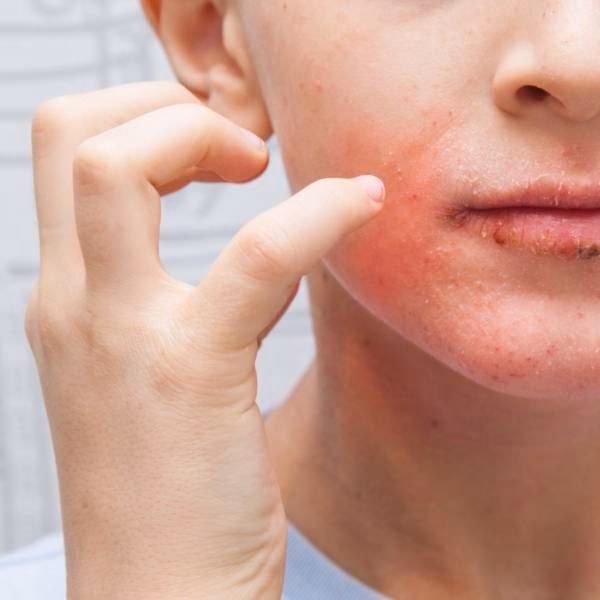 Quels sont les symptômes des boutons autour de la bouche ?