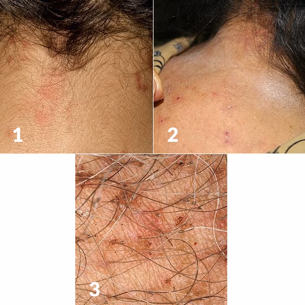 Quels sont les symptômes d'une réaction allergique à la teinture des cheveux ?