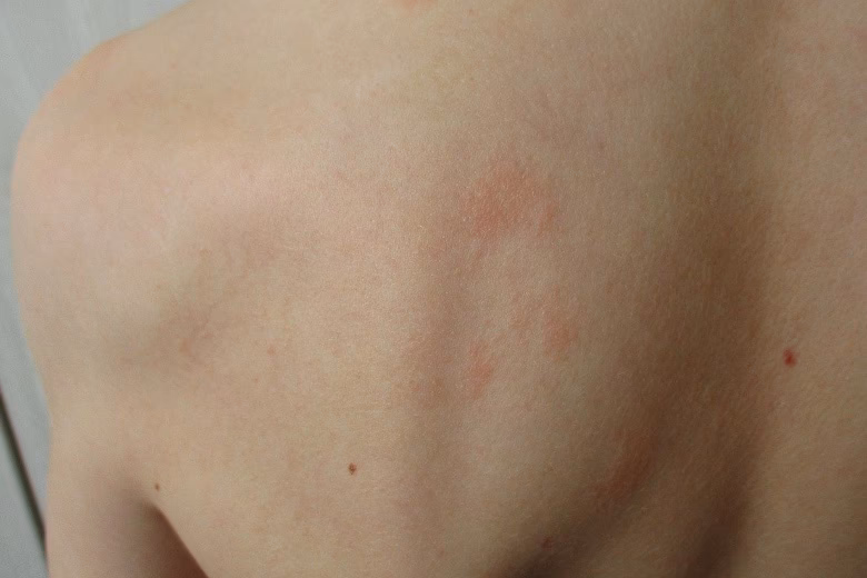 Was tun bei Chlorallergie im Trinkwasser?