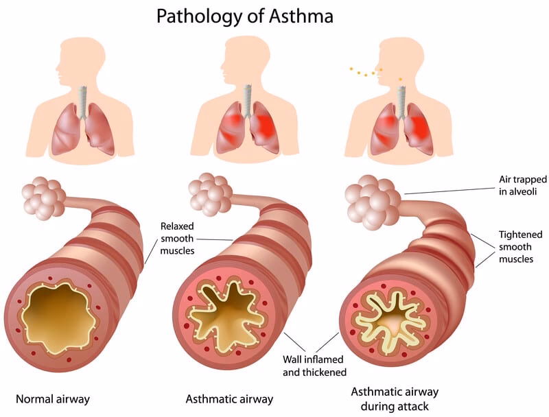 Wie wirkt sich allergisches Asthma auf die Lunge aus?
