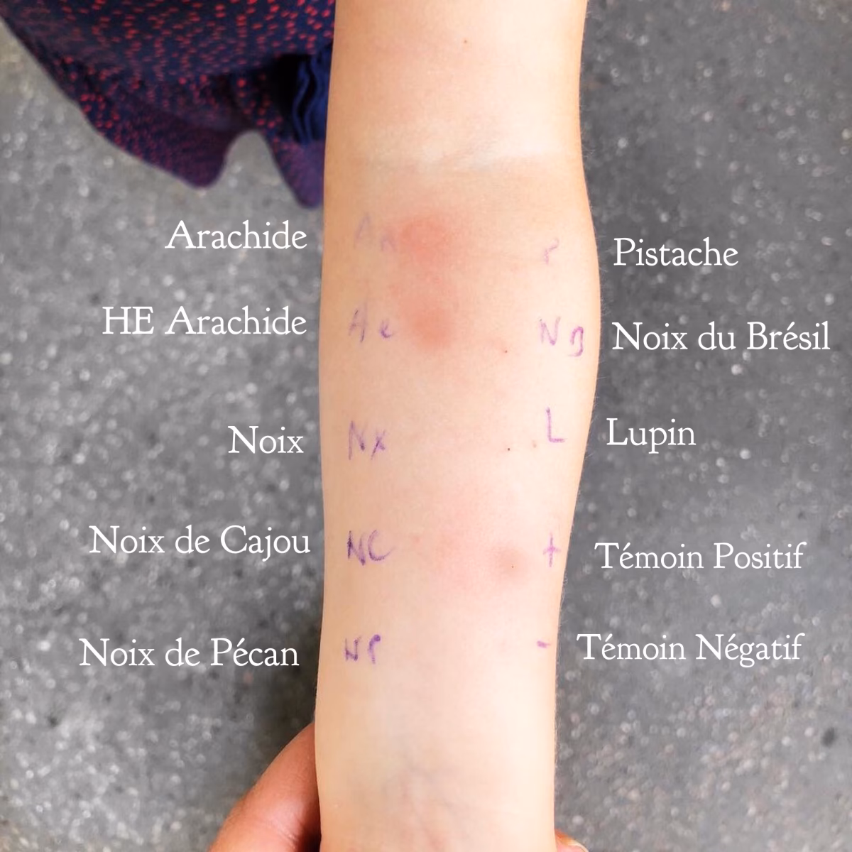 Quels sont les symptômes de l’allergie à la noix ?