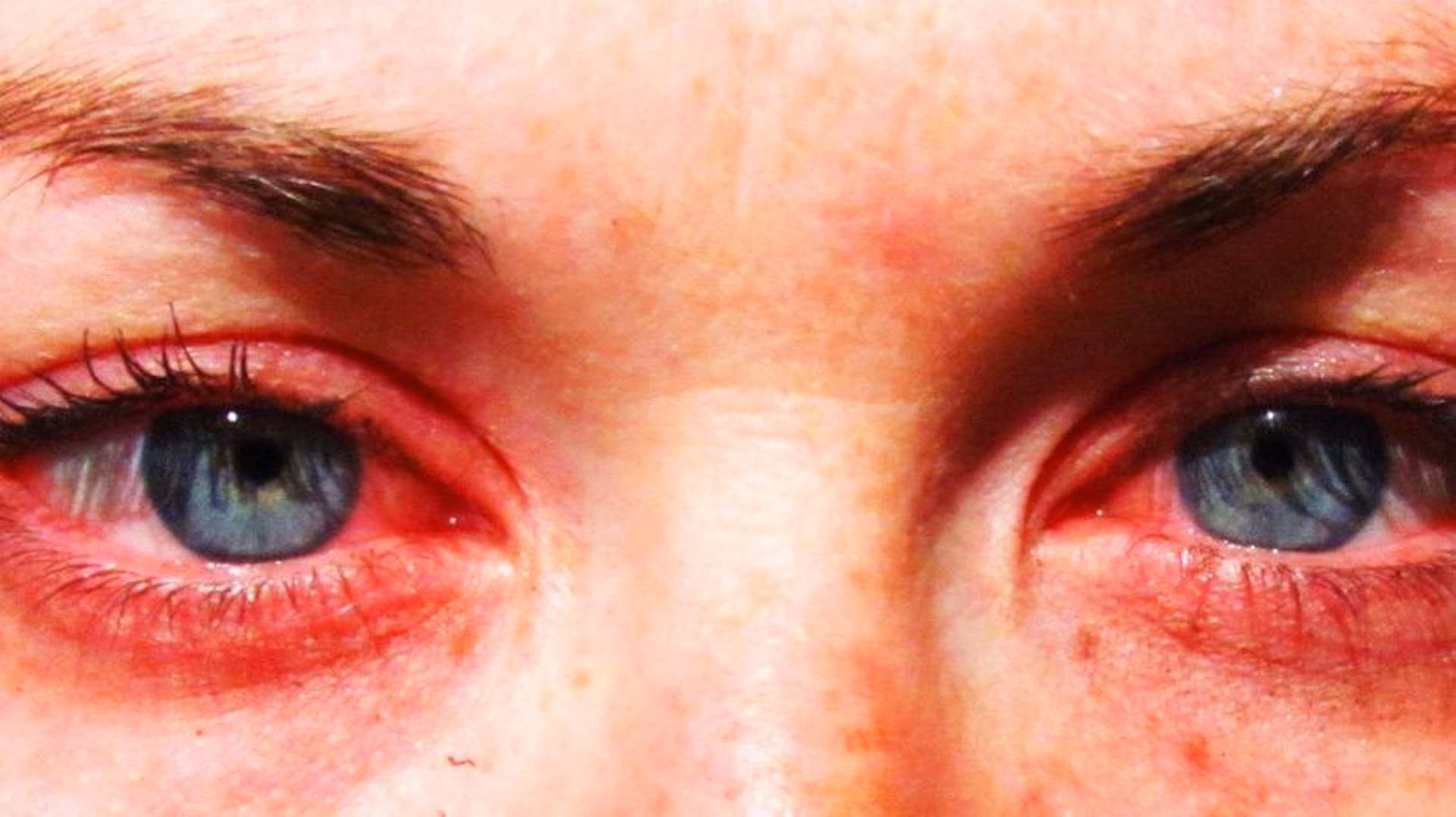 Quels sont les différents types d'allergies?