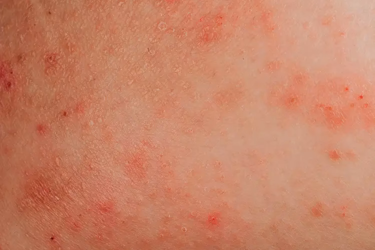 Can a burning sensation on the skin be a sign of allergies?