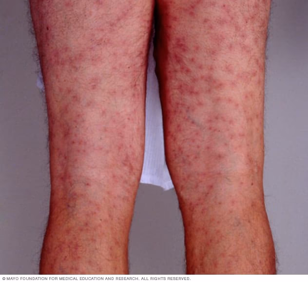 Can a lake cause a swimmer's itch?