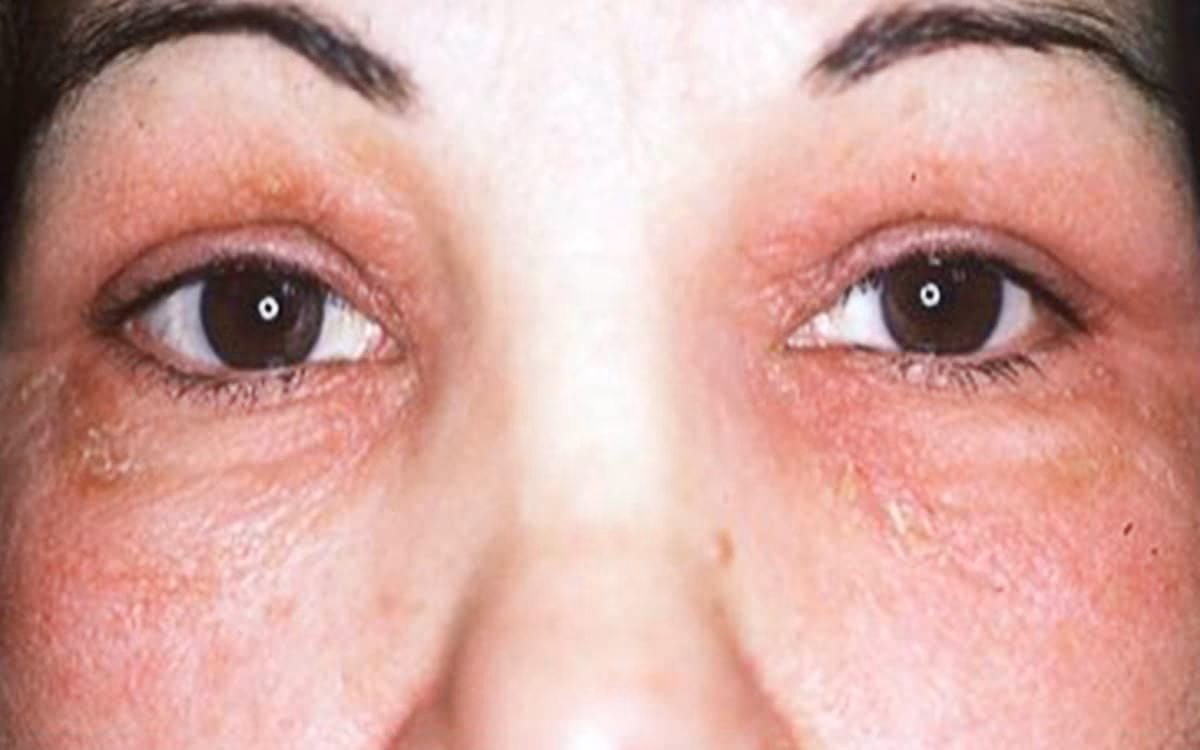 Pourquoi les yeux grattent-ils ?