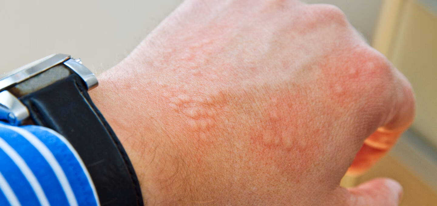 Is contact dermatitis a skin allergy?