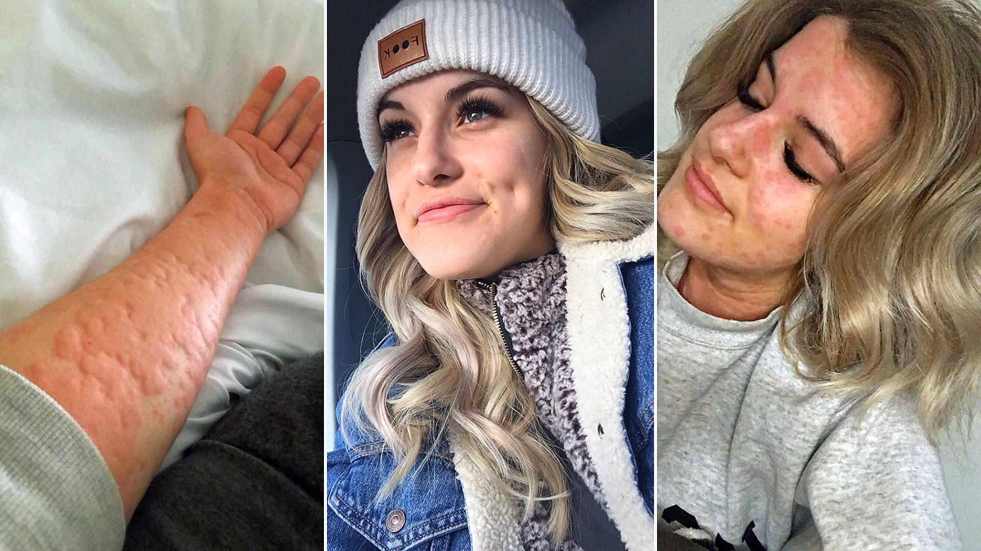 How does temperature affect allergies?