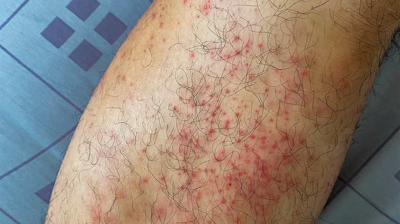 Is a rash affecting the lower legs a type of dermatitis?