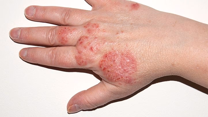 Are food allergies making eczema flare?