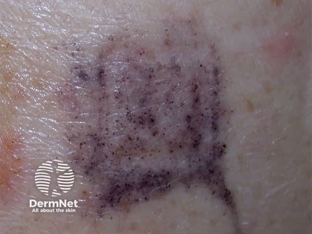 Are dye allergies a problem?