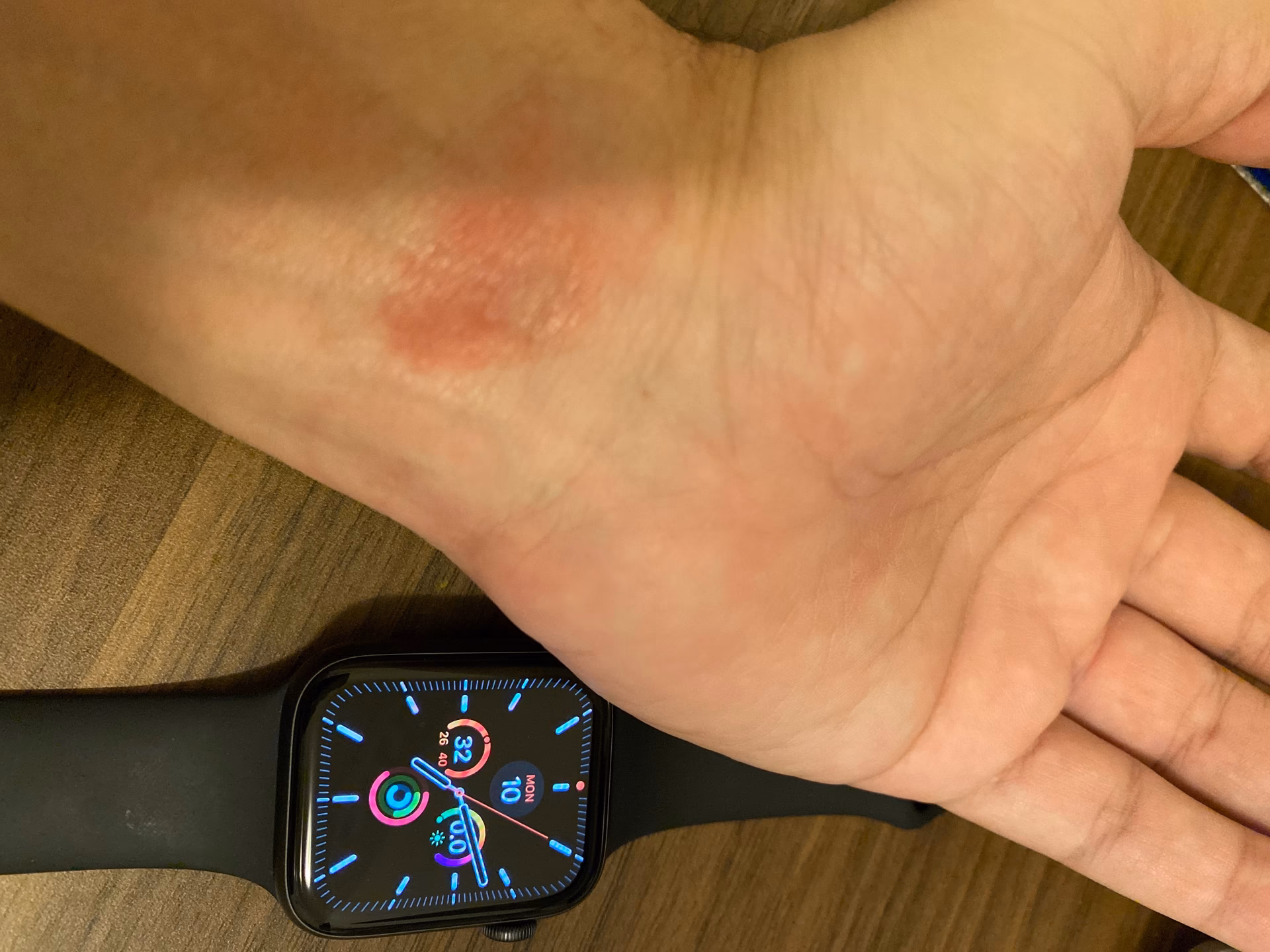 Do hypoallergenic watches cause a reaction?