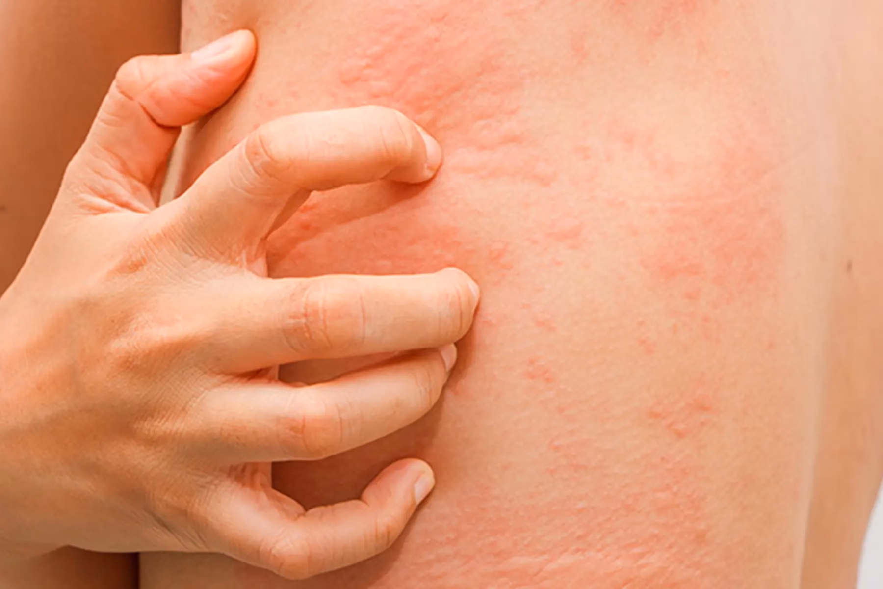 How do I know if I'm allergic to amoxicillin?