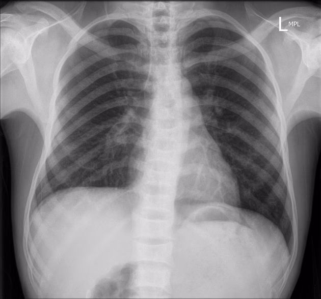 How do I know if I have anemia?