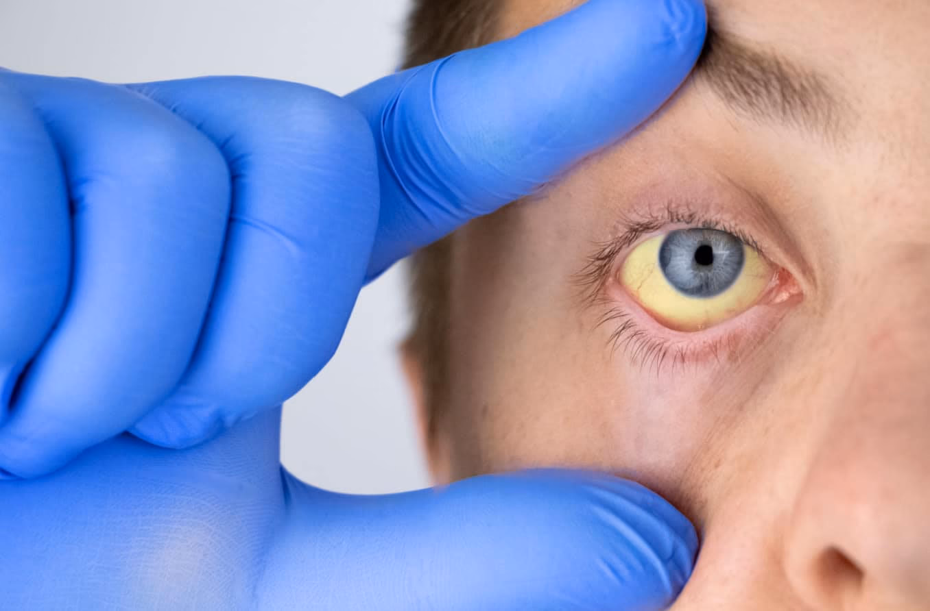 How does anemic retinopathy affect your eyes?