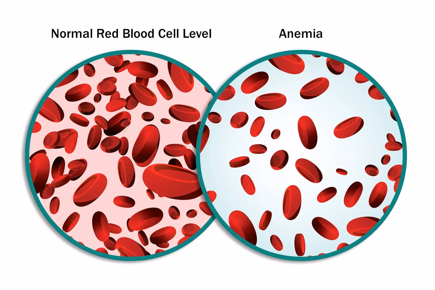 Can immunosuppressive therapy cause anemia in female MG patients?