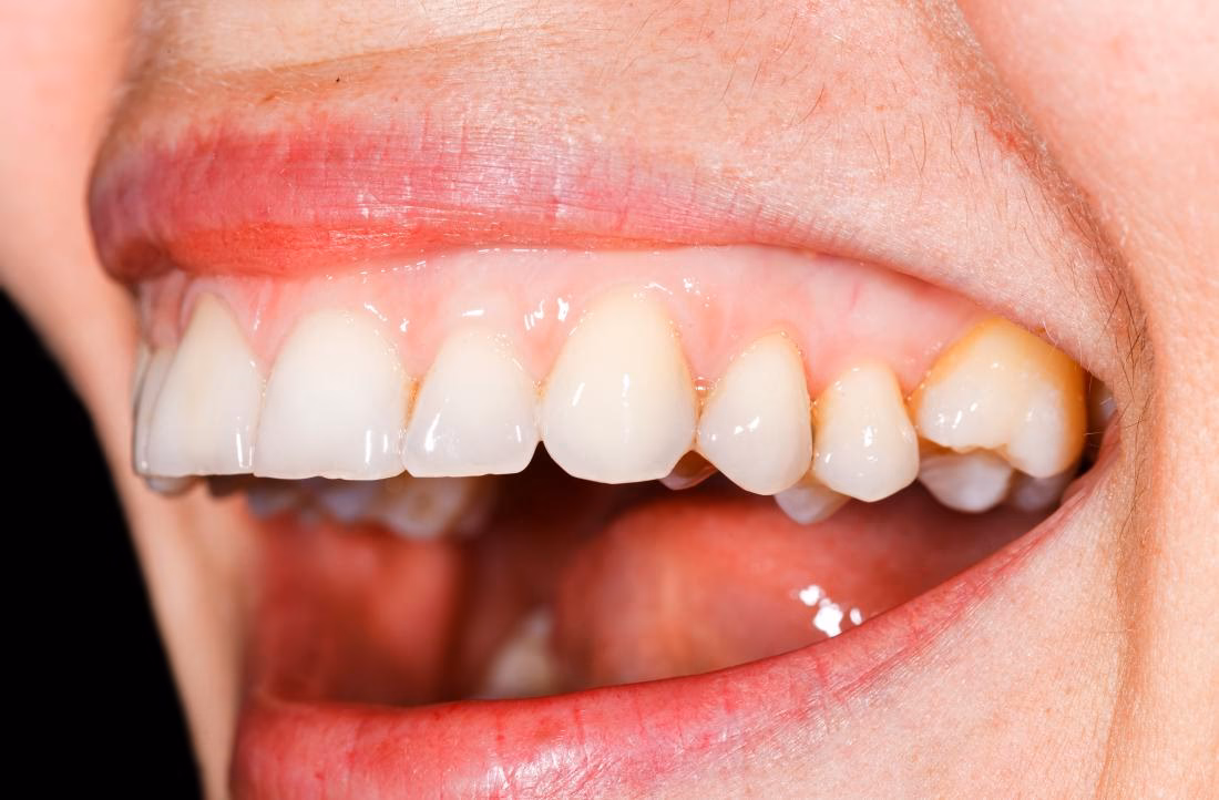 Why do my gums look pale if I have anemia?