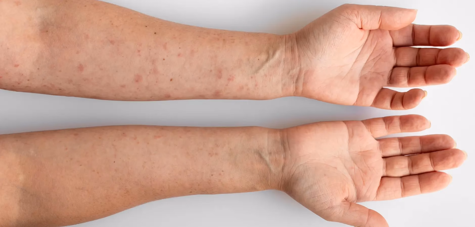 Was ist ein Anaphylaktisches Schock?