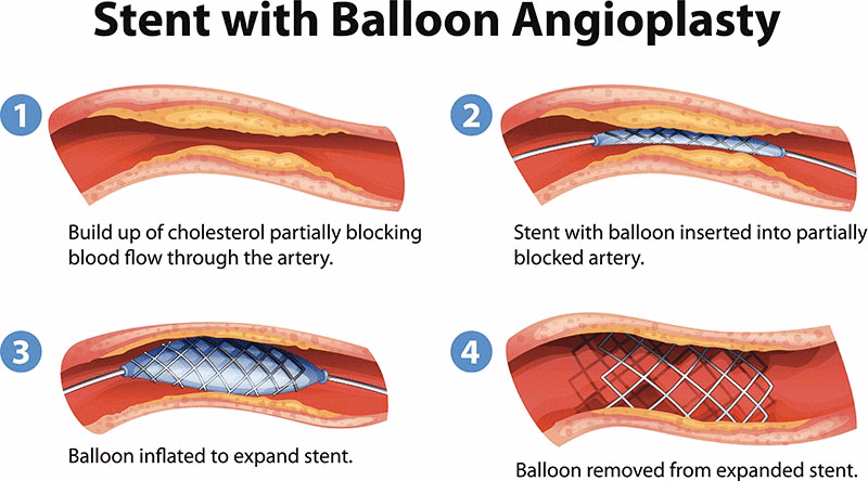 Should I get an angioplasty procedure in my legs?
