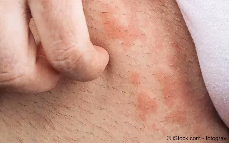 Welche Antibiotika können zu Sonnenempfindlichkeit führen?