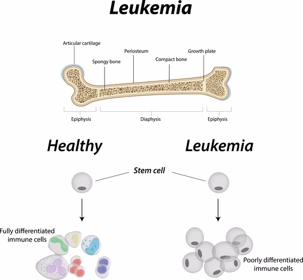 What does APL stand for?