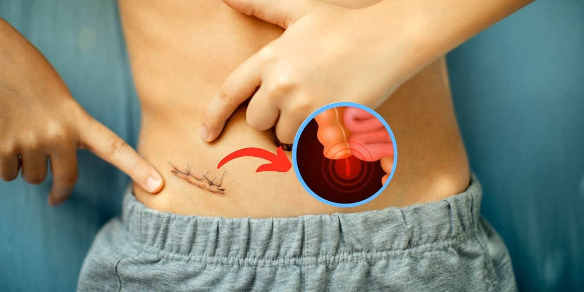 How does a doctor remove an appendix?